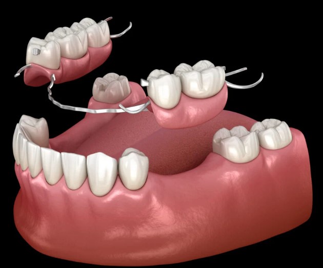 Dental flipper vs Partial denture