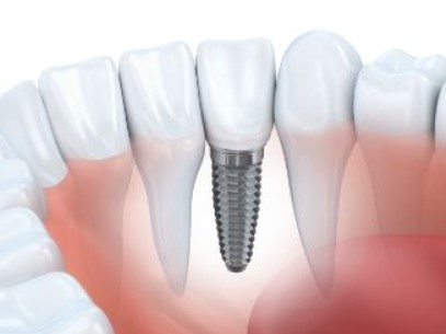 Lower Partial Dentures Bottom Front Teeth