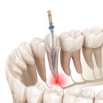 Root Canal