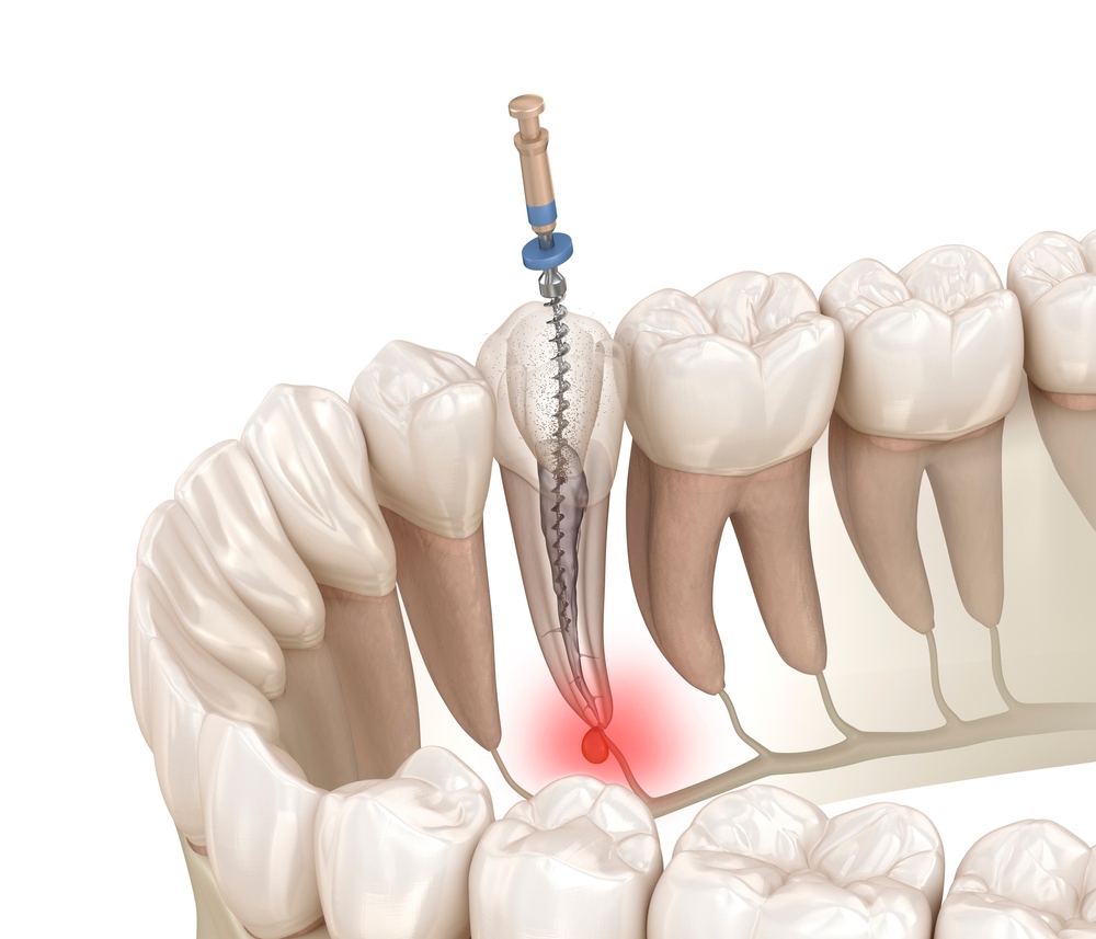 Root Canal