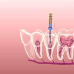 root canal cost in Canada