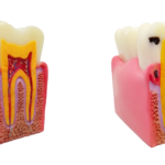 root canal before and after