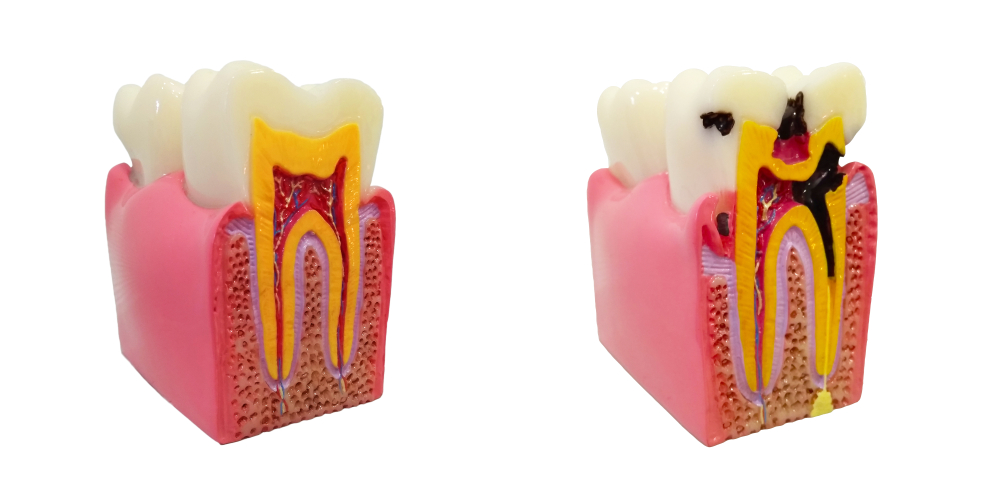 root canal before and after