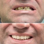 before and after denture