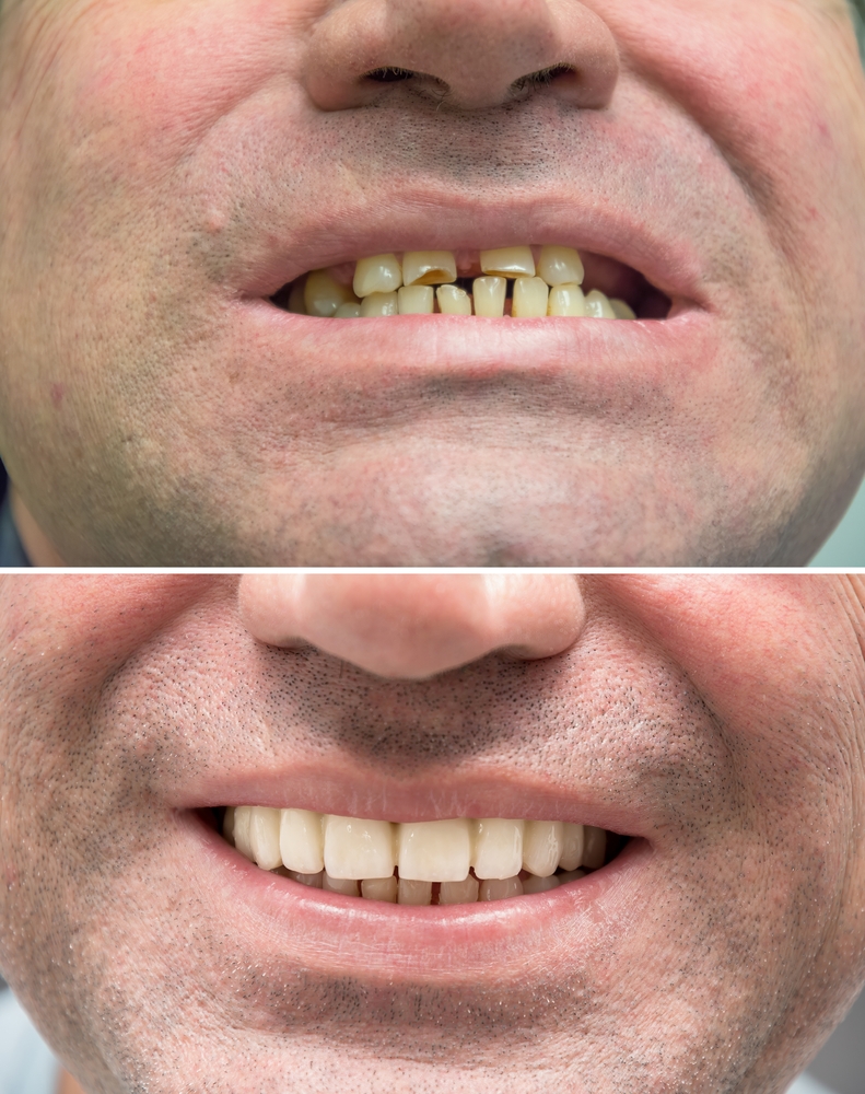 before and after denture