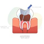 dead tooth root canal before and after