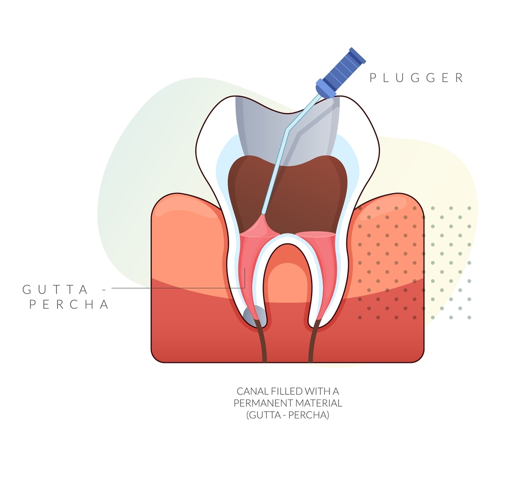 dead tooth root canal before and after