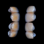 Dental crown vs veneer