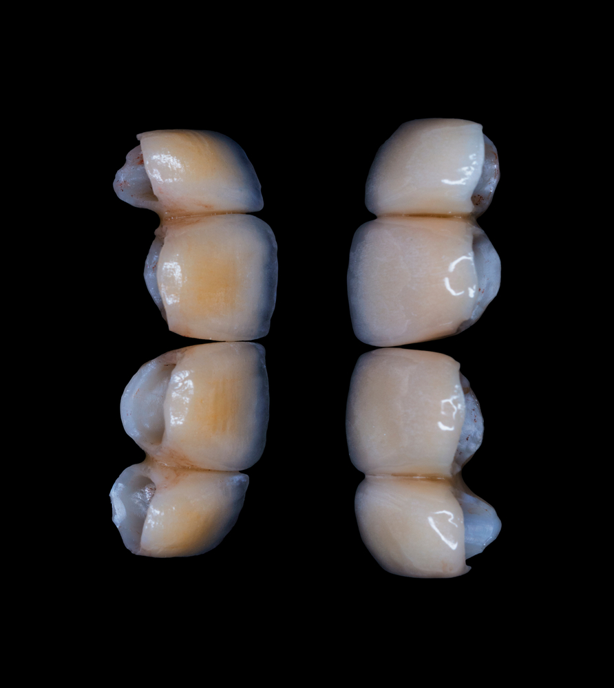 Dental crown vs veneer