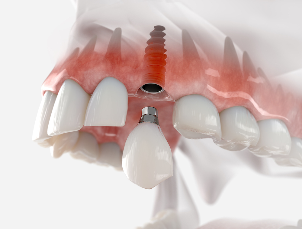 Realistic dentures before and after