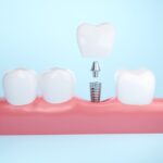 How long do dental implants last