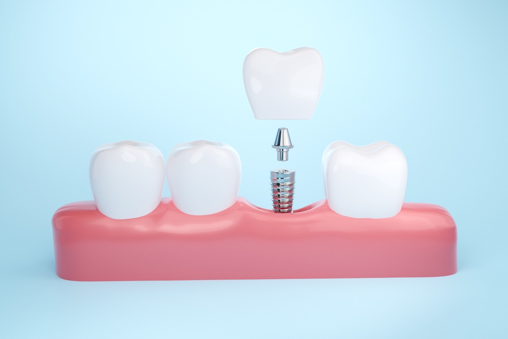 How long do dental implants last