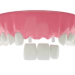 Partial dentures for front teeth