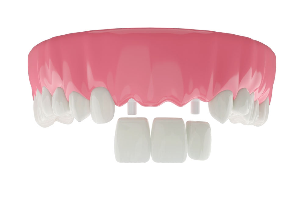 Partial dentures for front teeth