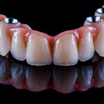 Full mouth dental implants