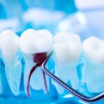 How much is a root canal in Ontario