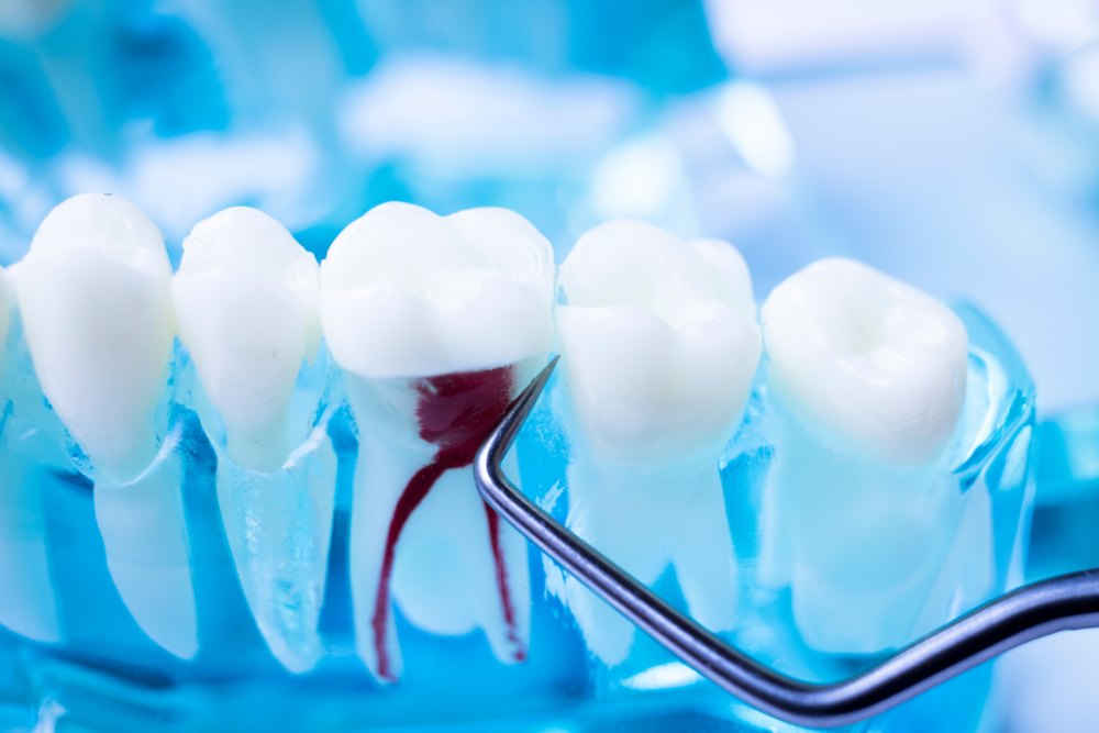 How much is a root canal in Ontario